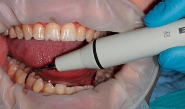 Акция на проф.гигиену полости рта у стоматолога