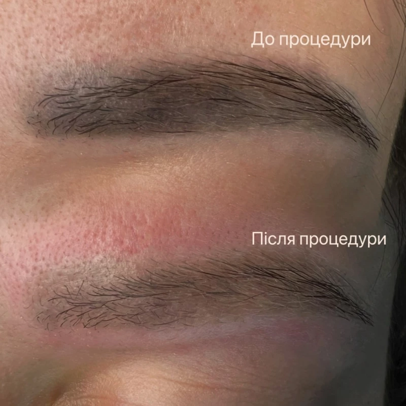 Лазерне видалення тату, татуажу та перманенту, Луцк — 2/4